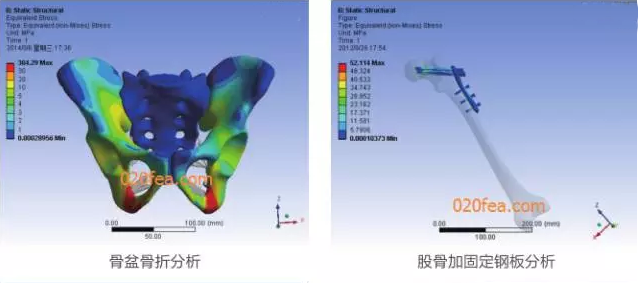 有限元分析法在結(jié)構(gòu)、醫(yī)學(xué)、流體與熱及電場的分析與應(yīng)用